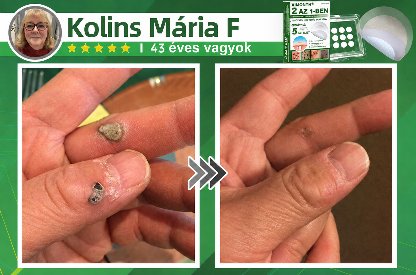 👉𝐗𝐈𝐌𝐎𝐍𝐓𝐇® 𝟐-𝐚𝐳-𝟏-𝐛𝐞𝐧 𝐌𝐢𝐤𝐫𝐨𝐭ű & 𝐇𝐢𝐝𝐫𝐨𝐤𝐨𝐥𝐨𝐢𝐝 𝐓𝐚𝐩𝐚𝐬𝐳 🇭🇺|👩🧒Kiemelkedő Anyajegyek, Pattanások, Lapos Szemölcsök & Bőrkinövések Eltávolítója | Ráncok, Hegek & Bőrhibák Javítása | Láthatatlan Csillag Pattanástapasz Arcra & Testre | 144 db