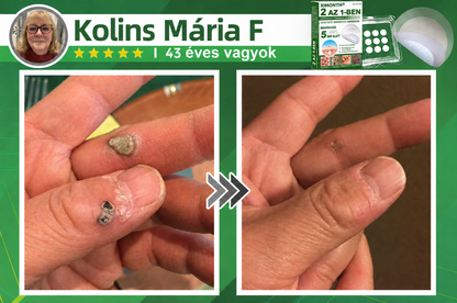 👉𝐗𝐈𝐌𝐎𝐍𝐓𝐇® 𝟐-𝐚𝐳-𝟏-𝐛𝐞𝐧 𝐌𝐢𝐤𝐫𝐨𝐭ű & 𝐇𝐢𝐝𝐫𝐨𝐤𝐨𝐥𝐨𝐢𝐝 𝐓𝐚𝐩𝐚𝐬𝐳 🇭🇺|👩🧒Kiemelkedő Anyajegyek, Pattanások, Lapos Szemölcsök & Bőrkinövések Eltávolítója | Ráncok, Hegek & Bőrhibák Javítása | Láthatatlan Csillag Pattanástapasz Arcra & Testre | 144 db