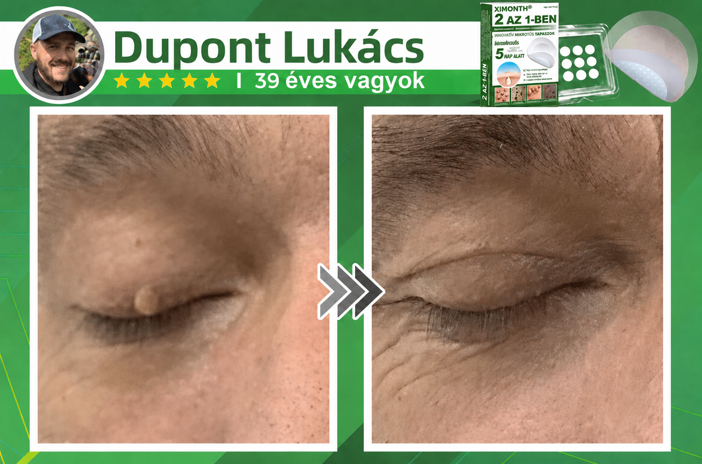 👉𝐗𝐈𝐌𝐎𝐍𝐓𝐇® 𝟐-𝐚𝐳-𝟏-𝐛𝐞𝐧 𝐌𝐢𝐤𝐫𝐨𝐭ű & 𝐇𝐢𝐝𝐫𝐨𝐤𝐨𝐥𝐨𝐢𝐝 𝐓𝐚𝐩𝐚𝐬𝐳 🇭🇺|👩🧒Kiemelkedő Anyajegyek, Pattanások, Lapos Szemölcsök & Bőrkinövések Eltávolítója | Ráncok, Hegek & Bőrhibák Javítása | Láthatatlan Csillag Pattanástapasz Arcra & Testre | 144 db