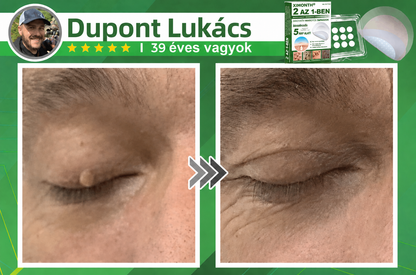 👉𝐗𝐈𝐌𝐎𝐍𝐓𝐇® 𝟐-𝐚𝐳-𝟏-𝐛𝐞𝐧 𝐌𝐢𝐤𝐫𝐨𝐭ű & 𝐇𝐢𝐝𝐫𝐨𝐤𝐨𝐥𝐨𝐢𝐝 𝐓𝐚𝐩𝐚𝐬𝐳 🇭🇺|👩🧒Kiemelkedő Anyajegyek, Pattanások, Lapos Szemölcsök & Bőrkinövések Eltávolítója | Ráncok, Hegek & Bőrhibák Javítása | Láthatatlan Csillag Pattanástapasz Arcra & Testre | 144 db