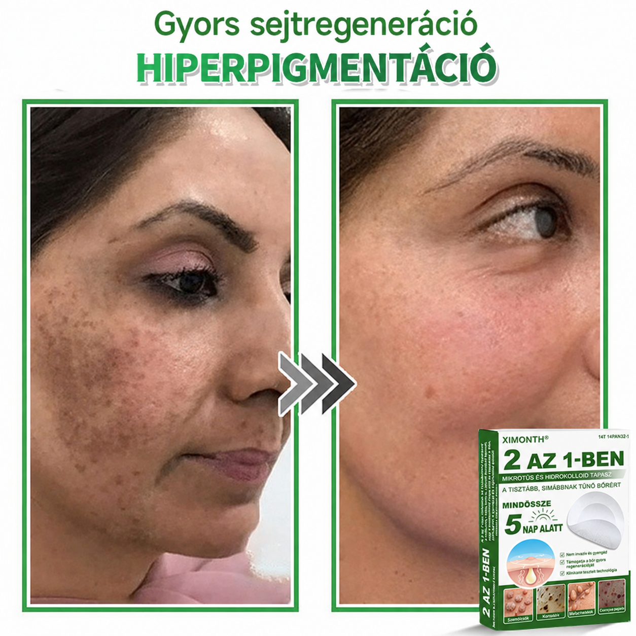 👉𝐗𝐈𝐌𝐎𝐍𝐓𝐇® 𝟐-𝐚𝐳-𝟏-𝐛𝐞𝐧 𝐌𝐢𝐤𝐫𝐨𝐭ű & 𝐇𝐢𝐝𝐫𝐨𝐤𝐨𝐥𝐨𝐢𝐝 𝐓𝐚𝐩𝐚𝐬𝐳 🇭🇺|👩🧒Kiemelkedő Anyajegyek, Pattanások, Lapos Szemölcsök & Bőrkinövések Eltávolítója | Ráncok, Hegek & Bőrhibák Javítása | Láthatatlan Csillag Pattanástapasz Arcra & Testre | 144 db