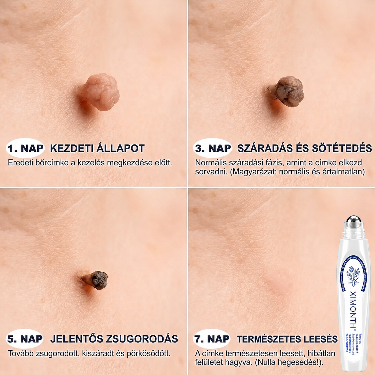 Hivatalos Márkabolt | 🚢🚢 𝐗𝐈𝐌𝐎𝐍𝐓𝐇® 7 napos Szemölcseltávolító Roll-on Ápoló Folyadék (Fájdalommentes rollerball technológia, hegek nélkül) 🐬