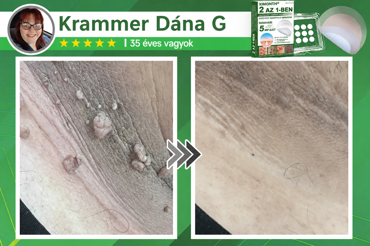 👉𝐗𝐈𝐌𝐎𝐍𝐓𝐇® 𝟐-𝐚𝐳-𝟏-𝐛𝐞𝐧 𝐌𝐢𝐤𝐫𝐨𝐭ű & 𝐇𝐢𝐝𝐫𝐨𝐤𝐨𝐥𝐨𝐢𝐝 𝐓𝐚𝐩𝐚𝐬𝐳 🇭🇺|👩🧒Kiemelkedő Anyajegyek, Pattanások, Lapos Szemölcsök & Bőrkinövések Eltávolítója | Ráncok, Hegek & Bőrhibák Javítása | Láthatatlan Csillag Pattanástapasz Arcra & Testre | 144 db