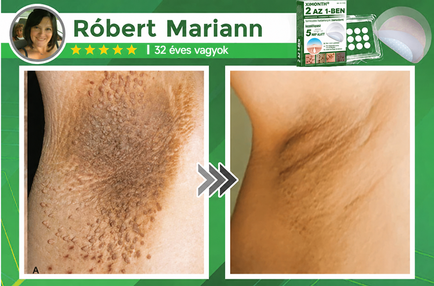 👉𝐗𝐈𝐌𝐎𝐍𝐓𝐇® 𝟐-𝐚𝐳-𝟏-𝐛𝐞𝐧 𝐌𝐢𝐤𝐫𝐨𝐭ű & 𝐇𝐢𝐝𝐫𝐨𝐤𝐨𝐥𝐨𝐢𝐝 𝐓𝐚𝐩𝐚𝐬𝐳 🇭🇺|👩🧒Kiemelkedő Anyajegyek, Pattanások, Lapos Szemölcsök & Bőrkinövések Eltávolítója | Ráncok, Hegek & Bőrhibák Javítása | Láthatatlan Csillag Pattanástapasz Arcra & Testre | 144 db