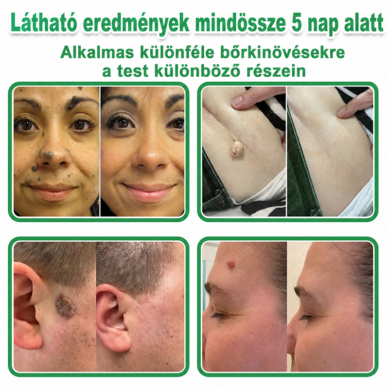 👉𝐗𝐈𝐌𝐎𝐍𝐓𝐇® 𝟐-𝐚𝐳-𝟏-𝐛𝐞𝐧 𝐌𝐢𝐤𝐫𝐨𝐭ű & 𝐇𝐢𝐝𝐫𝐨𝐤𝐨𝐥𝐨𝐢𝐝 𝐓𝐚𝐩𝐚𝐬𝐳 🇭🇺|👩🧒Kiemelkedő Anyajegyek, Pattanások, Lapos Szemölcsök & Bőrkinövések Eltávolítója | Ráncok, Hegek & Bőrhibák Javítása | Láthatatlan Csillag Pattanástapasz Arcra & Testre | 144 db