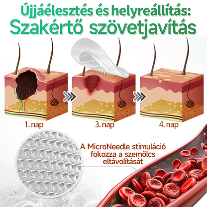 👉𝐗𝐈𝐌𝐎𝐍𝐓𝐇® 𝟐-𝐚𝐳-𝟏-𝐛𝐞𝐧 𝐌𝐢𝐤𝐫𝐨𝐭ű & 𝐇𝐢𝐝𝐫𝐨𝐤𝐨𝐥𝐨𝐢𝐝 𝐓𝐚𝐩𝐚𝐬𝐳 🇭🇺|👩🧒Kiemelkedő Anyajegyek, Pattanások, Lapos Szemölcsök & Bőrkinövések Eltávolítója | Ráncok, Hegek & Bőrhibák Javítása | Láthatatlan Csillag Pattanástapasz Arcra & Testre | 144 db