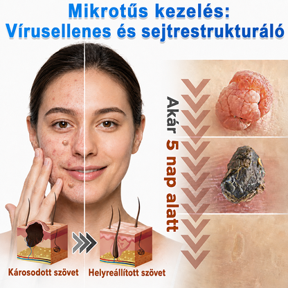 👉𝐗𝐈𝐌𝐎𝐍𝐓𝐇® 𝟐-𝐚𝐳-𝟏-𝐛𝐞𝐧 𝐌𝐢𝐤𝐫𝐨𝐭ű & 𝐇𝐢𝐝𝐫𝐨𝐤𝐨𝐥𝐨𝐢𝐝 𝐓𝐚𝐩𝐚𝐬𝐳 🇭🇺|👩🧒Kiemelkedő Anyajegyek, Pattanások, Lapos Szemölcsök & Bőrkinövések Eltávolítója | Ráncok, Hegek & Bőrhibák Javítása | Láthatatlan Csillag Pattanástapasz Arcra & Testre | 144 db
