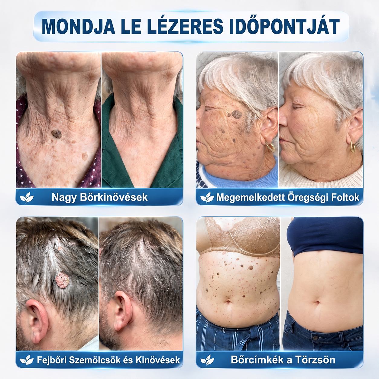 Hivatalos Márkabolt | 🚢🚢 𝐗𝐈𝐌𝐎𝐍𝐓𝐇® 7 napos Szemölcseltávolító Roll-on Ápoló Folyadék (Fájdalommentes rollerball technológia, hegek nélkül) 🐬