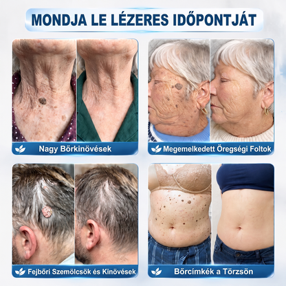 Hivatalos Márkabolt | 🚢🚢 𝐗𝐈𝐌𝐎𝐍𝐓𝐇® 7 napos Szemölcseltávolító Roll-on Ápoló Folyadék (Fájdalommentes rollerball technológia, hegek nélkül) 🐬