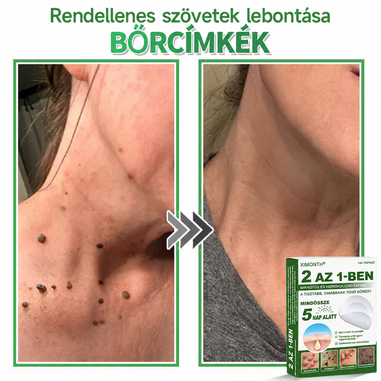👉𝐗𝐈𝐌𝐎𝐍𝐓𝐇® 𝟐-𝐚𝐳-𝟏-𝐛𝐞𝐧 𝐌𝐢𝐤𝐫𝐨𝐭ű & 𝐇𝐢𝐝𝐫𝐨𝐤𝐨𝐥𝐨𝐢𝐝 𝐓𝐚𝐩𝐚𝐬𝐳 🇭🇺|👩🧒Kiemelkedő Anyajegyek, Pattanások, Lapos Szemölcsök & Bőrkinövések Eltávolítója | Ráncok, Hegek & Bőrhibák Javítása | Láthatatlan Csillag Pattanástapasz Arcra & Testre | 144 db