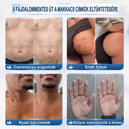 Hivatalos Márkabolt | 🚢🚢 𝐗𝐈𝐌𝐎𝐍𝐓𝐇® 7 napos Szemölcseltávolító Roll-on Ápoló Folyadék (Fájdalommentes rollerball technológia, hegek nélkül) 🐬