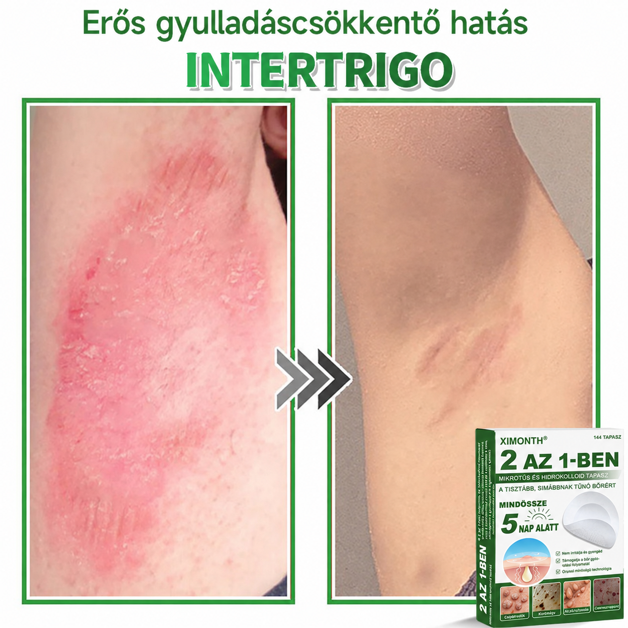 👉𝐗𝐈𝐌𝐎𝐍𝐓𝐇® 𝟐-𝐚𝐳-𝟏-𝐛𝐞𝐧 𝐌𝐢𝐤𝐫𝐨𝐭ű & 𝐇𝐢𝐝𝐫𝐨𝐤𝐨𝐥𝐨𝐢𝐝 𝐓𝐚𝐩𝐚𝐬𝐳 🇭🇺|👩🧒Kiemelkedő Anyajegyek, Pattanások, Lapos Szemölcsök & Bőrkinövések Eltávolítója | Ráncok, Hegek & Bőrhibák Javítása | Láthatatlan Csillag Pattanástapasz Arcra & Testre | 144 db