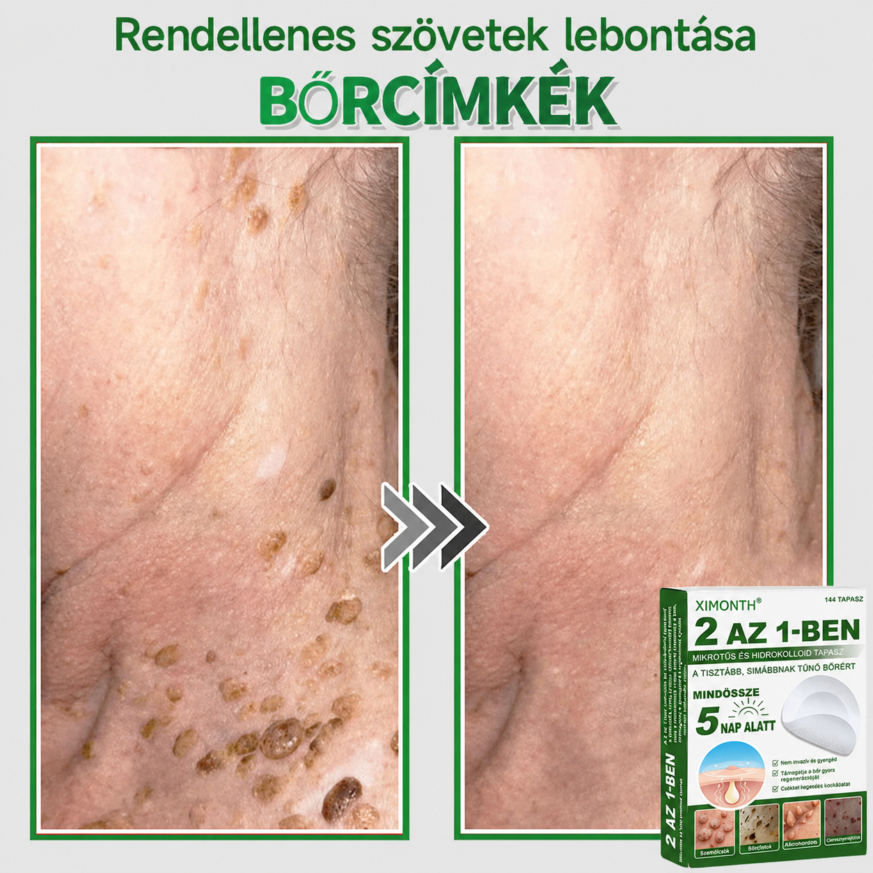 👉𝐗𝐈𝐌𝐎𝐍𝐓𝐇® 𝟐-𝐚𝐳-𝟏-𝐛𝐞𝐧 𝐌𝐢𝐤𝐫𝐨𝐭ű & 𝐇𝐢𝐝𝐫𝐨𝐤𝐨𝐥𝐨𝐢𝐝 𝐓𝐚𝐩𝐚𝐬𝐳 🇭🇺|👩🧒Kiemelkedő Anyajegyek, Pattanások, Lapos Szemölcsök & Bőrkinövések Eltávolítója | Ráncok, Hegek & Bőrhibák Javítása | Láthatatlan Csillag Pattanástapasz Arcra & Testre | 144 db