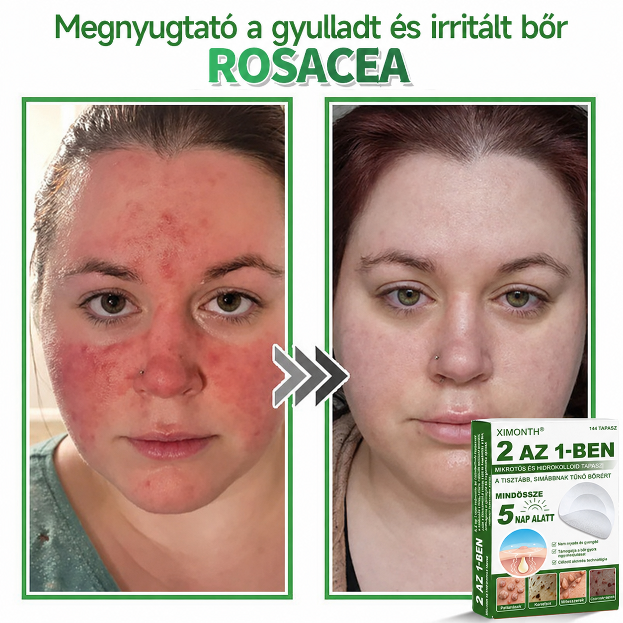👉𝐗𝐈𝐌𝐎𝐍𝐓𝐇® 𝟐-𝐚𝐳-𝟏-𝐛𝐞𝐧 𝐌𝐢𝐤𝐫𝐨𝐭ű & 𝐇𝐢𝐝𝐫𝐨𝐤𝐨𝐥𝐨𝐢𝐝 𝐓𝐚𝐩𝐚𝐬𝐳 🇭🇺|👩🧒Kiemelkedő Anyajegyek, Pattanások, Lapos Szemölcsök & Bőrkinövések Eltávolítója | Ráncok, Hegek & Bőrhibák Javítása | Láthatatlan Csillag Pattanástapasz Arcra & Testre | 144 db