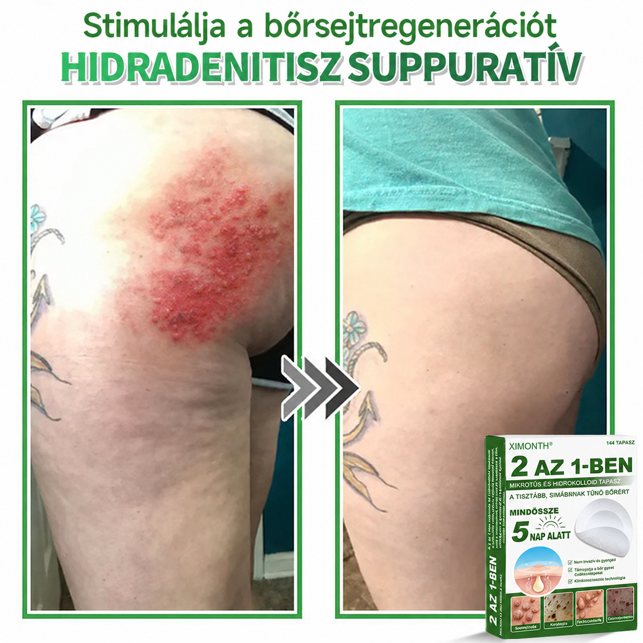 👉𝐗𝐈𝐌𝐎𝐍𝐓𝐇® 𝟐-𝐚𝐳-𝟏-𝐛𝐞𝐧 𝐌𝐢𝐤𝐫𝐨𝐭ű & 𝐇𝐢𝐝𝐫𝐨𝐤𝐨𝐥𝐨𝐢𝐝 𝐓𝐚𝐩𝐚𝐬𝐳 🇭🇺|👩🧒Kiemelkedő Anyajegyek, Pattanások, Lapos Szemölcsök & Bőrkinövések Eltávolítója | Ráncok, Hegek & Bőrhibák Javítása | Láthatatlan Csillag Pattanástapasz Arcra & Testre | 144 db