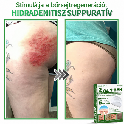 👉𝐗𝐈𝐌𝐎𝐍𝐓𝐇® 𝟐-𝐚𝐳-𝟏-𝐛𝐞𝐧 𝐌𝐢𝐤𝐫𝐨𝐭ű & 𝐇𝐢𝐝𝐫𝐨𝐤𝐨𝐥𝐨𝐢𝐝 𝐓𝐚𝐩𝐚𝐬𝐳 🇭🇺|👩🧒Kiemelkedő Anyajegyek, Pattanások, Lapos Szemölcsök & Bőrkinövések Eltávolítója | Ráncok, Hegek & Bőrhibák Javítása | Láthatatlan Csillag Pattanástapasz Arcra & Testre | 144 db